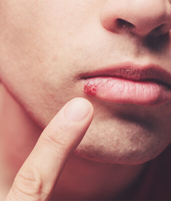 How does herpes look like